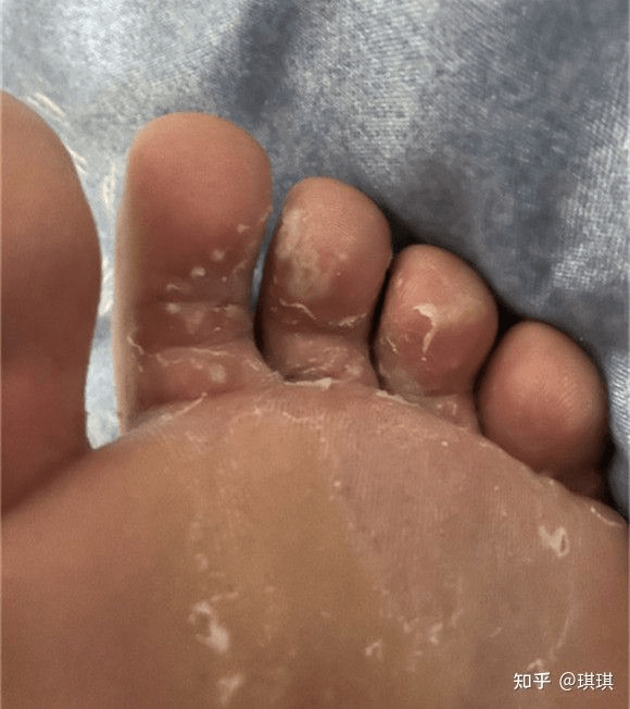 女生有脚气是怎样一种体验?