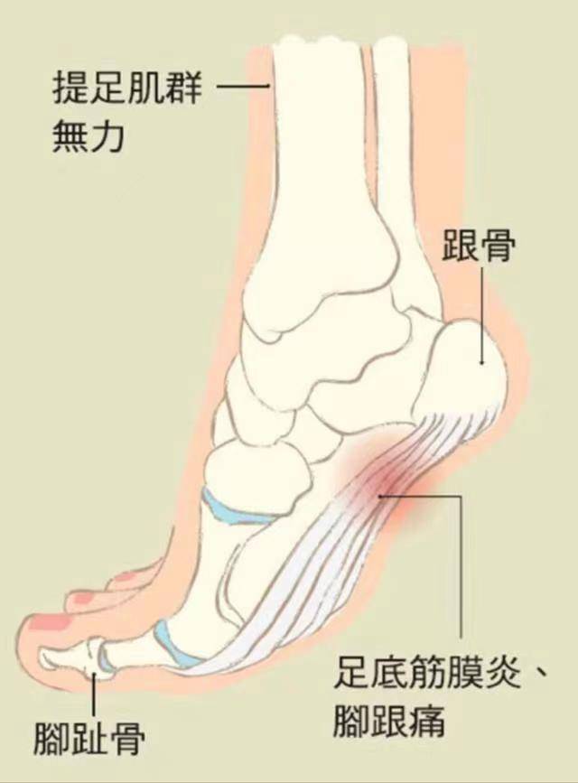 长期脚痛,可能是不同的疾病表现,要及时治疗!