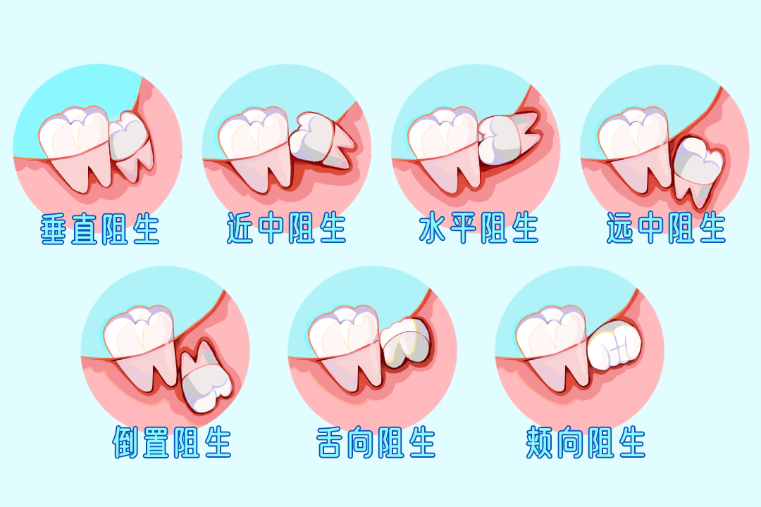 根据阻生智齿的长轴和第二磨牙的关系可分为垂直阻生,水平阻生,近中