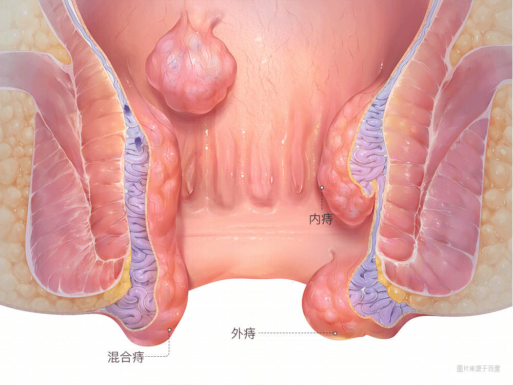 辩证看待痔疮微创手术—pph_并发症_黏膜_直肠