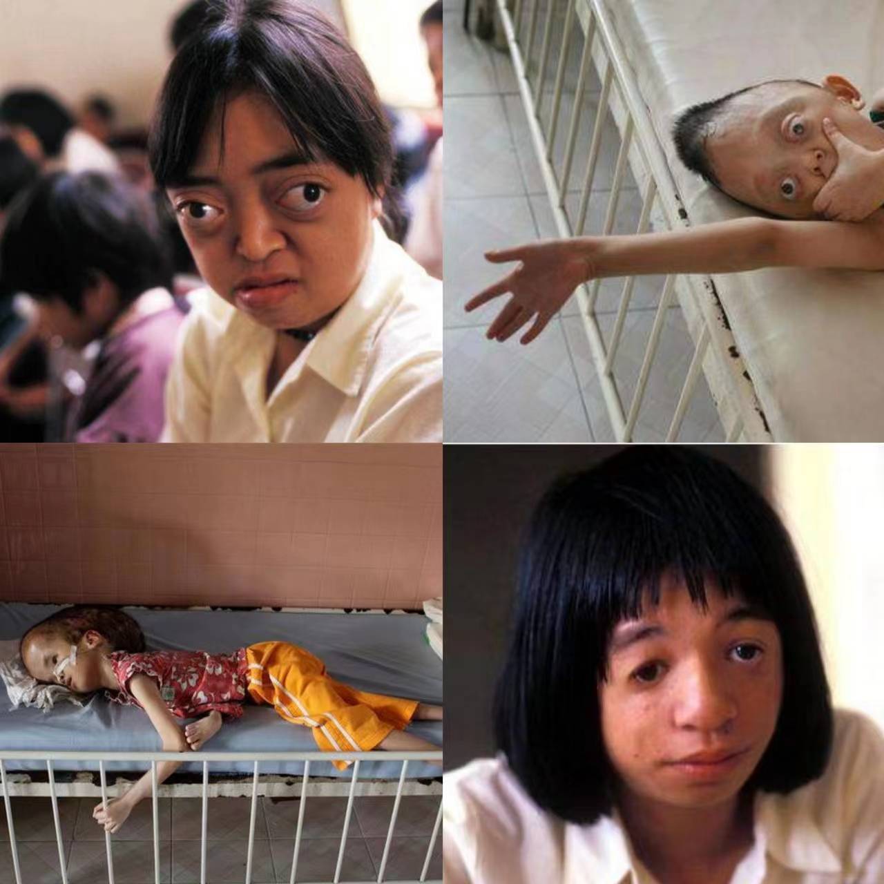 越南橙剂受害者图片