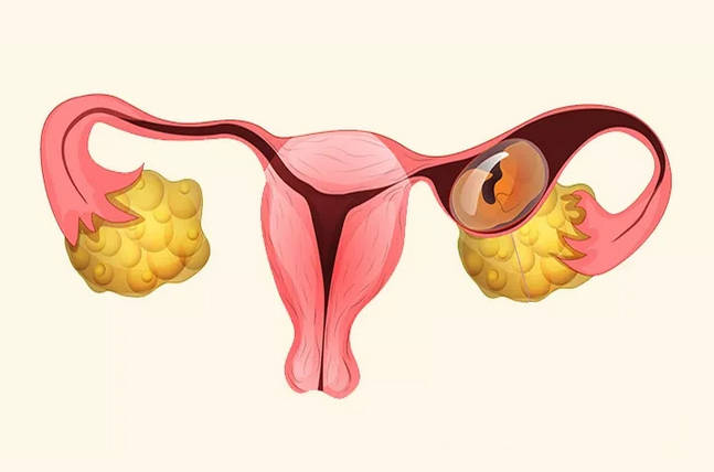 什么是宫外孕症状有哪些症状 如何预防？