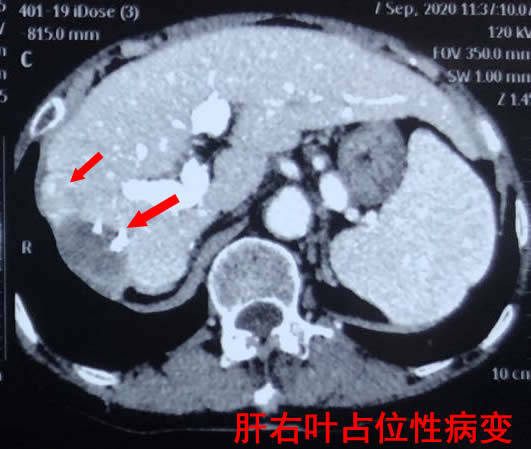 原发性肝癌在超声中的5大表现