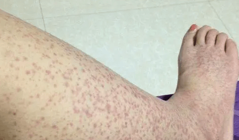 又多了几个小红点,是过敏性紫癜严重了吗?_病情_病程_治疗