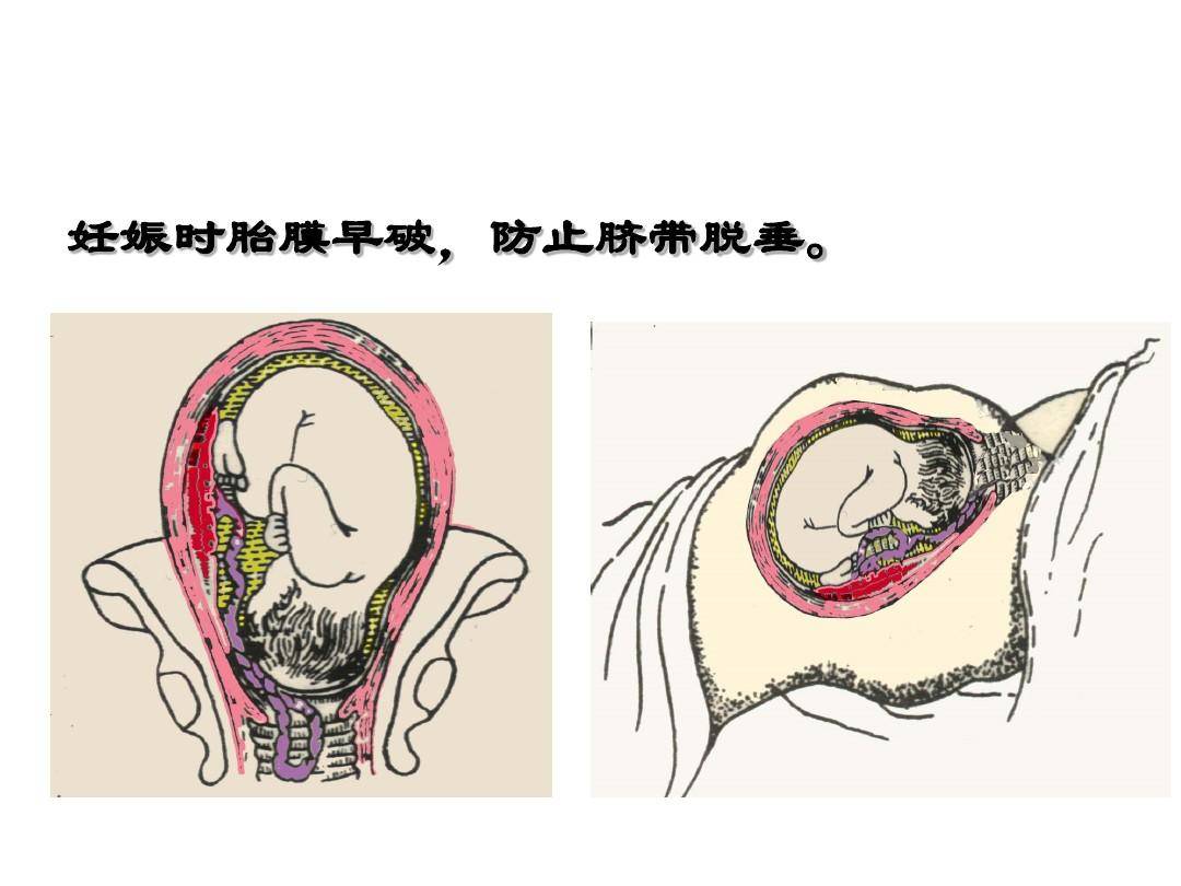 到了急救室,医生看她的临床表现,林女士应该是胎膜早破,必须要进行