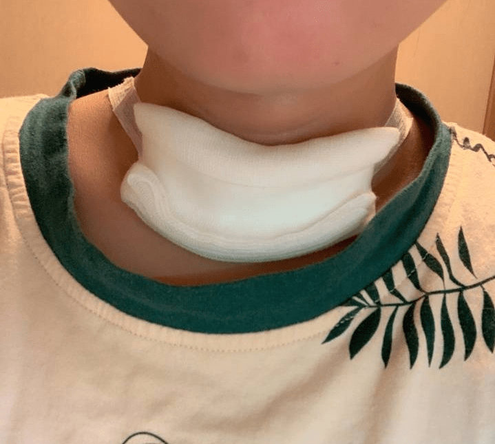 不敢看,第三天可以出院,7天后摘纱布洗澡,出现了最大的问题就是习惯性