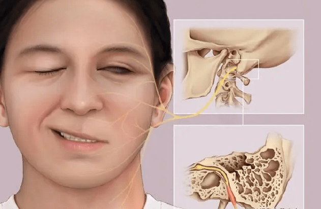 面肌痉挛的诱发因素及表现面肌痉挛主要是由血管压迫面神经引起的