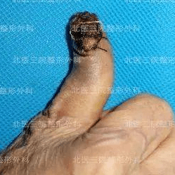 因为甲沟炎就被截掉了手指?-甲沟炎剪断了梗在里面