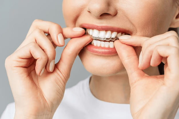 正畸治疗期间需要注意哪些牙石问题_牙齿_口腔_进行