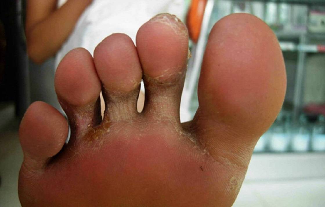 脚痒脚臭脚糜烂?过来人自用方法分享,再顽固的脚气都没了!