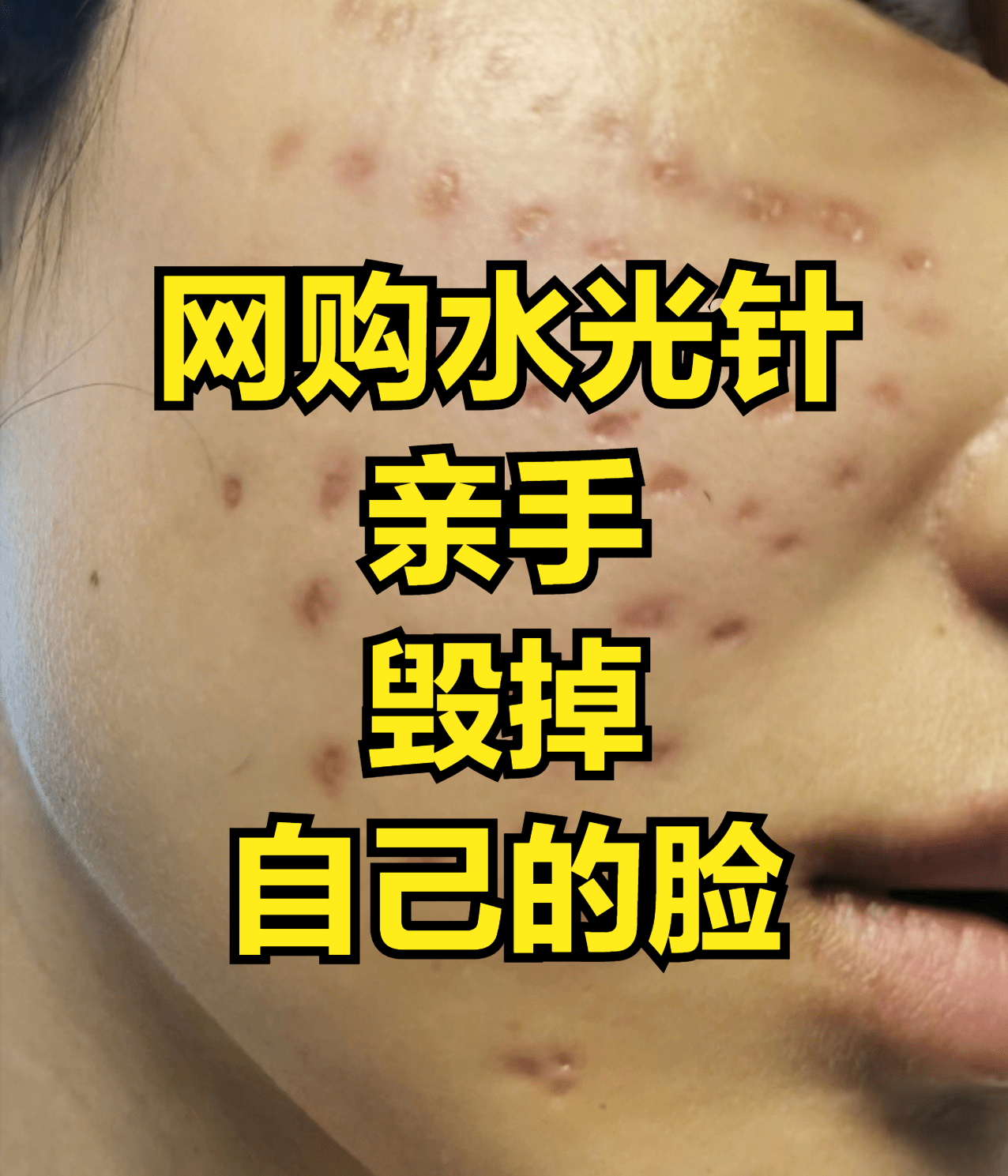 瘦脸针的危害有什么副作用_瘦脸针副作用对比照_瘦脸针的副作用可逆吗