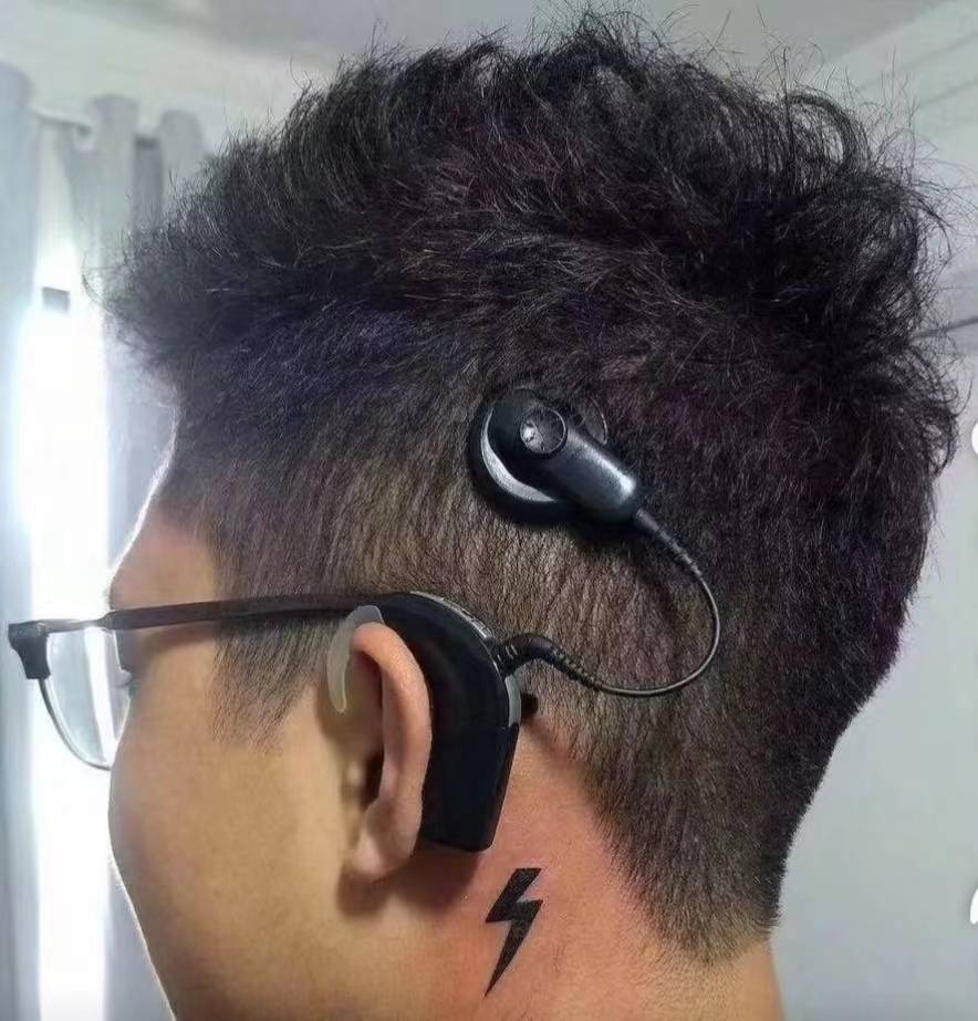 重庆助听器:助听器人工耳蜗双模干预案例!_用户_识别率_耳聋