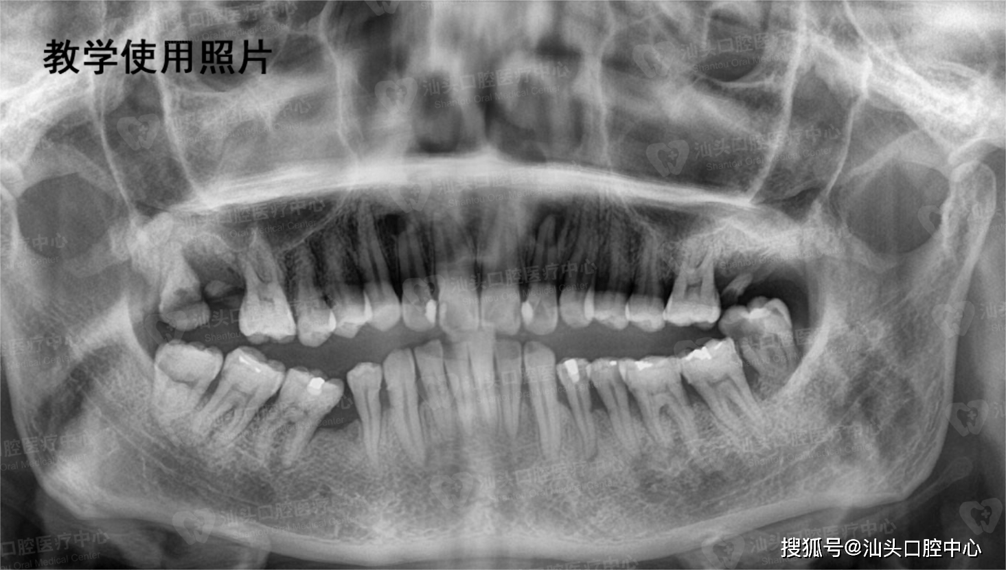 相隔四年的牙片对比令人感慨_智齿_口腔_治疗