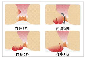 瘘疮和痔疮的区别图片图片