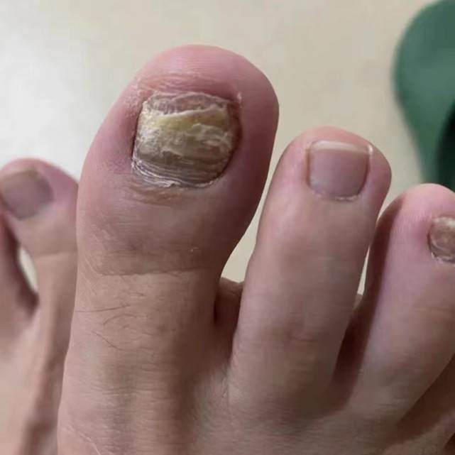 过来人曝光自用祛灰秘籍,每天几毛钱在家就能彻底根除灰指甲!