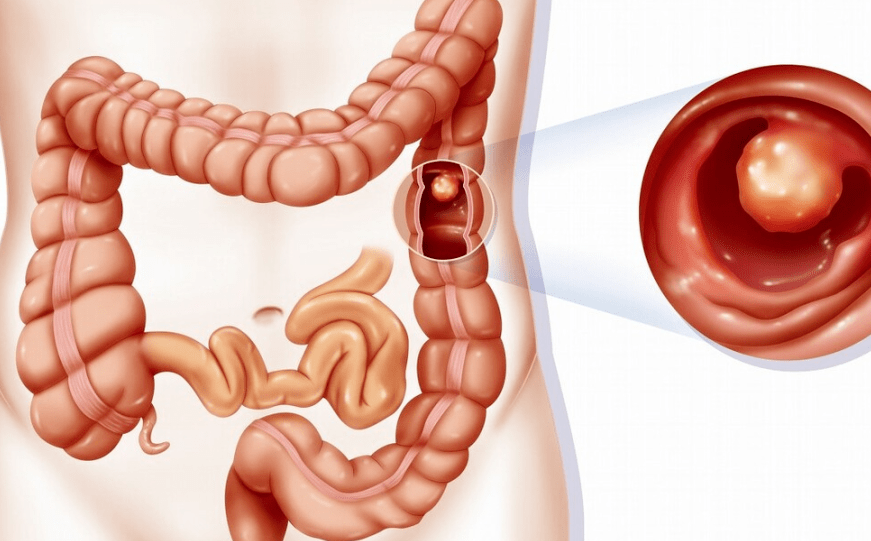医生呼吁:留意这3种病_粪便_肠道_身体