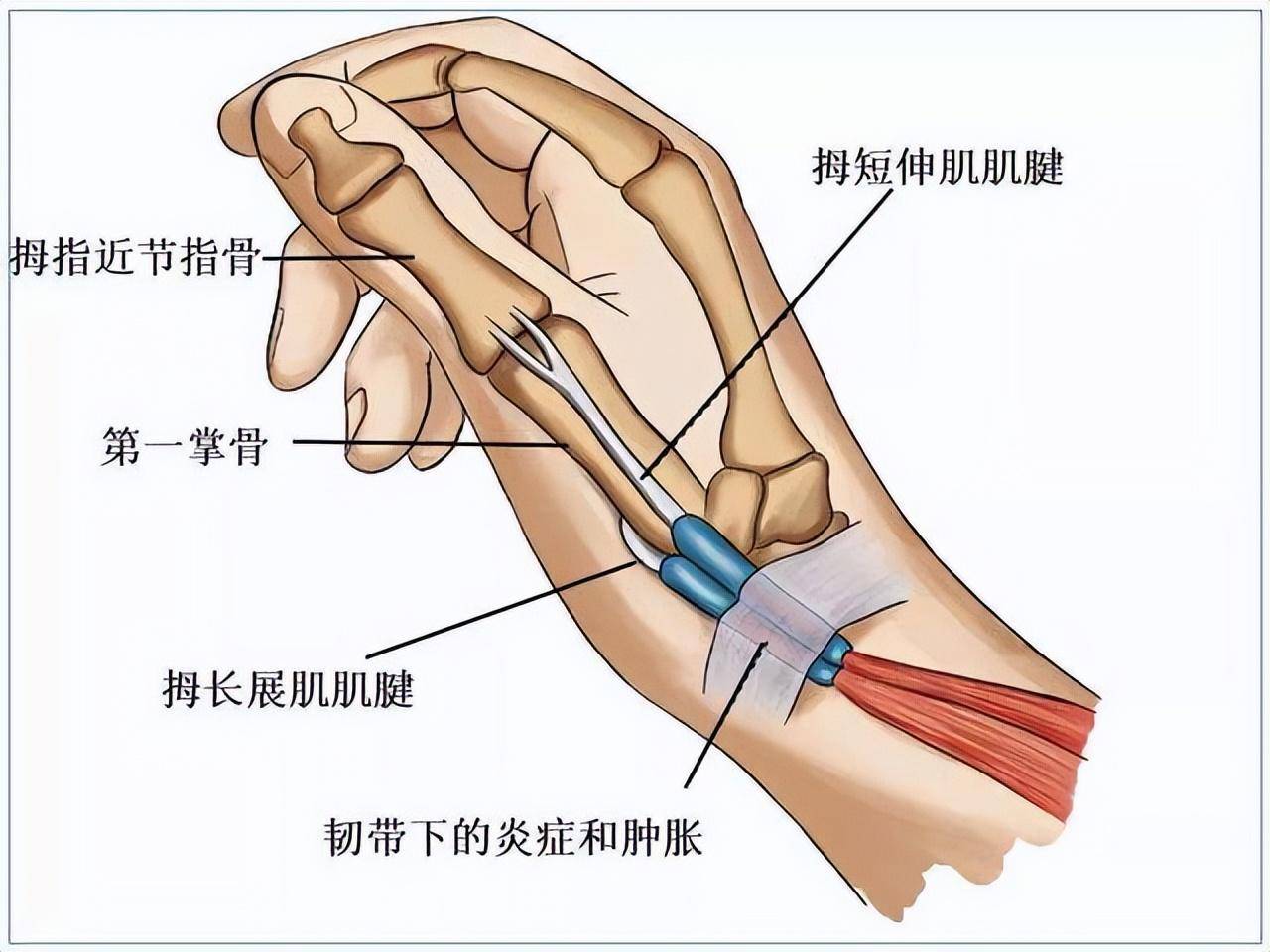 拇长屈肌肌腱炎图片