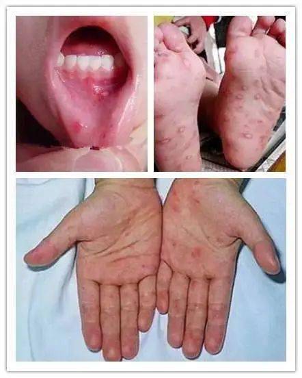 传染病防治手足口病进入感染高发季附一图读懂儿童手足口病防控和宣传