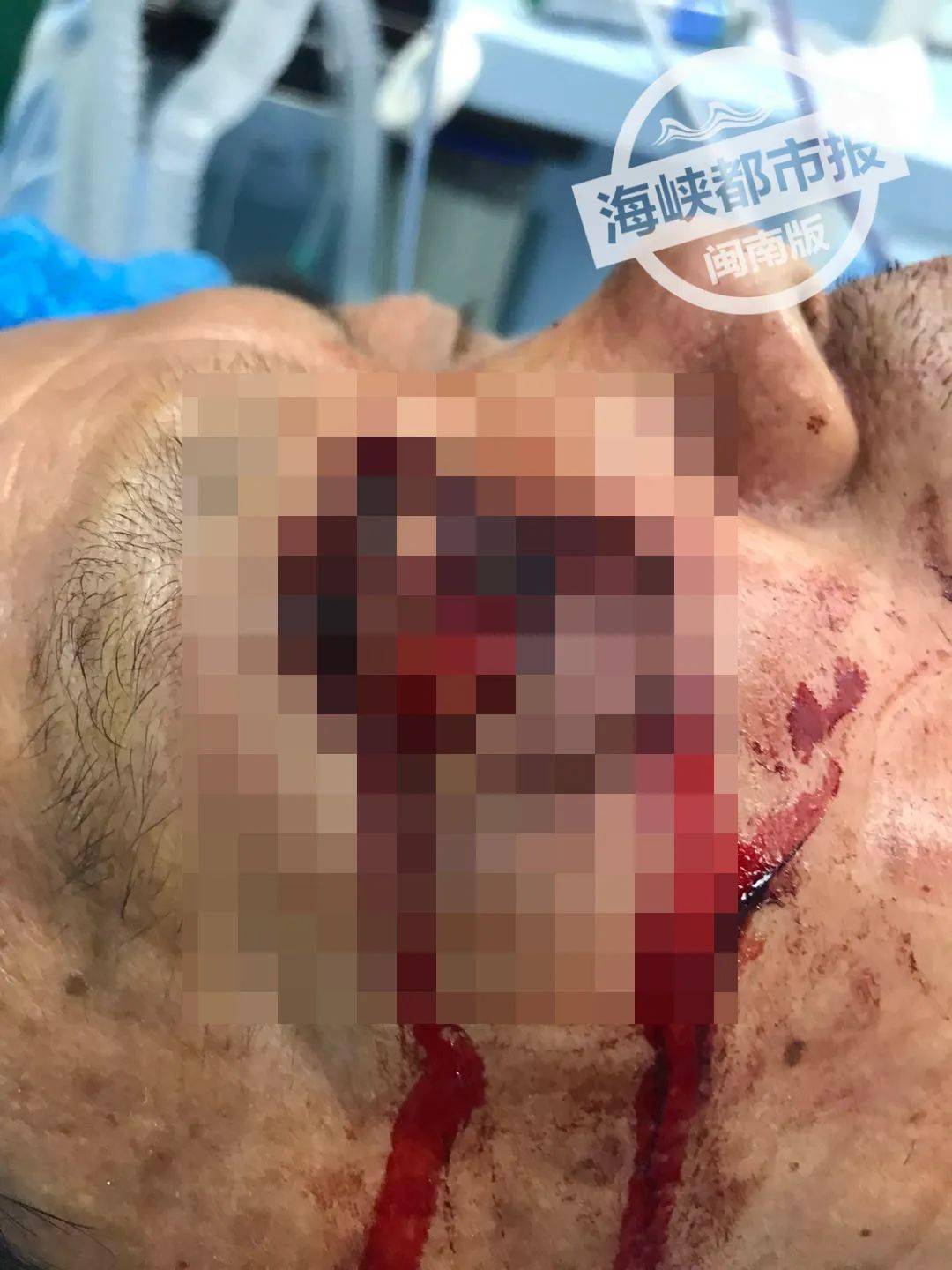 "种了回去"……医生又把掉出来眼球幸运的是眼球"夺眶而出"厦门一男子