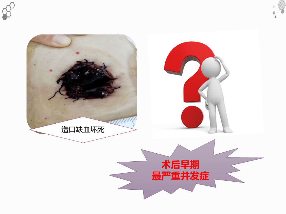 一例结肠癌术后肠造口缺血坏死护理查房