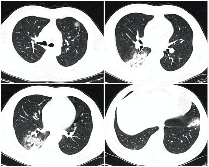 简单3点轻松鉴别细菌性肺炎与病毒性肺炎