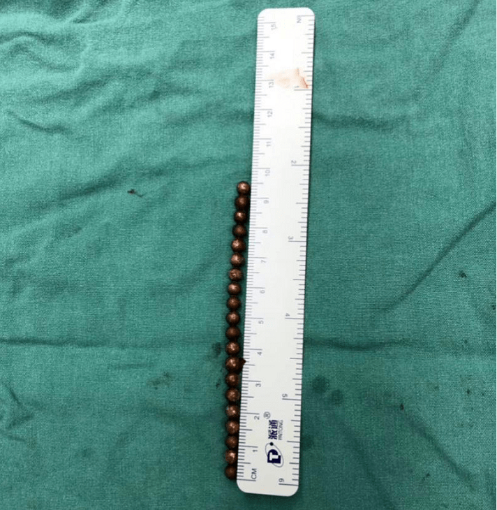 痛一11岁男童在膀胱里藏着20颗磁力珠