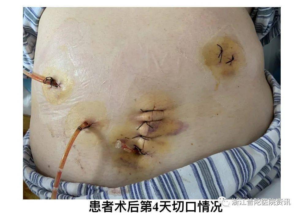 钙化上皮瘤手术后图片图片