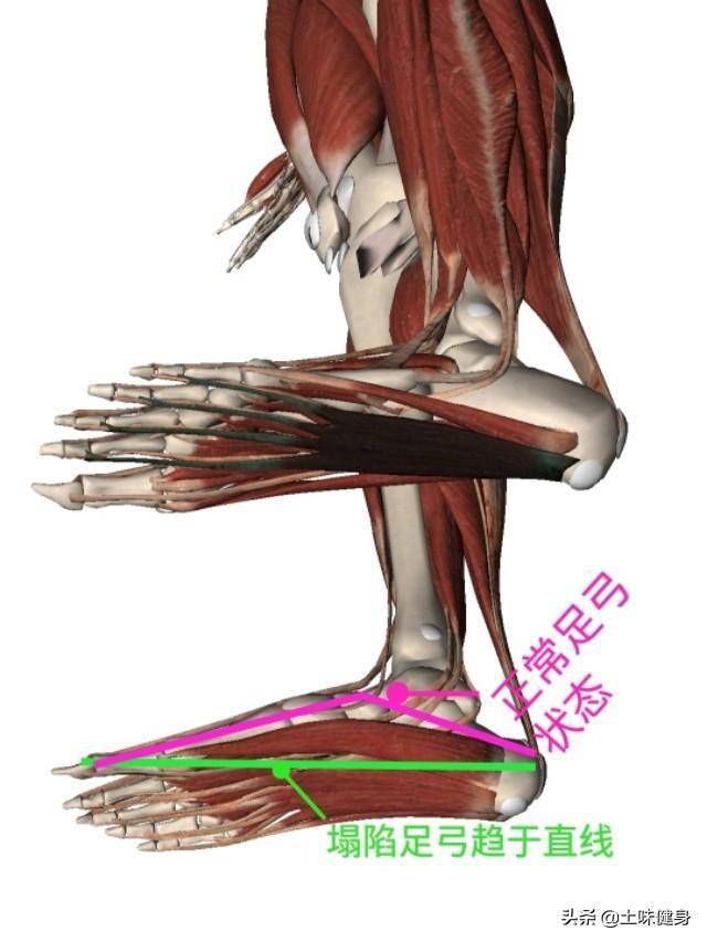 腿型不好膝關節不適並非表面看到的足弓問題值得注意