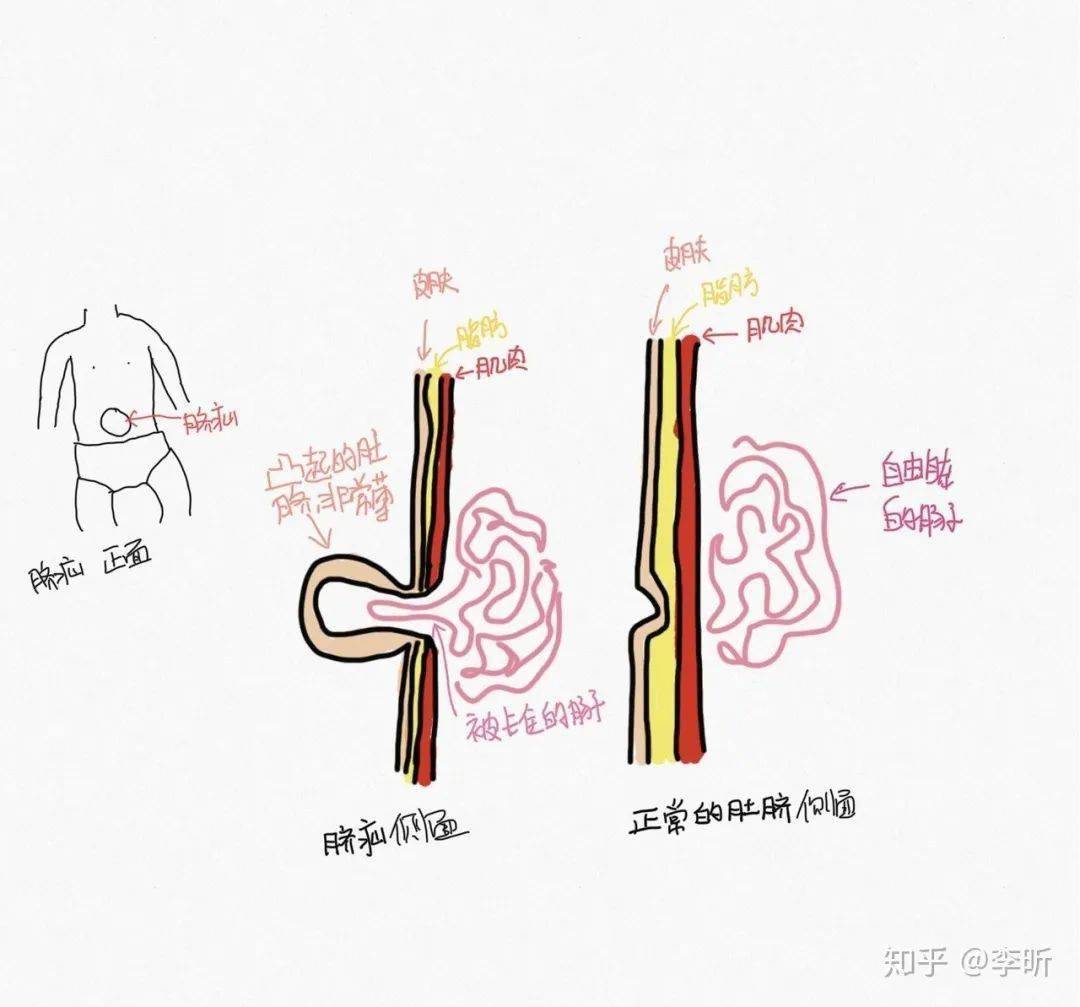 脐疝示意图,自己画的