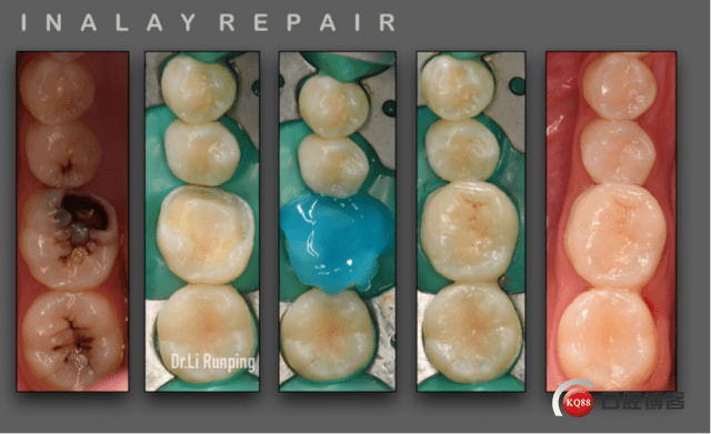 右下第92磨93根管治疗高嵌体修复92例