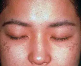 色斑性肌肤的诊断及处理方法_黑色素