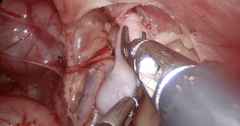 隐睾手术过程图片
