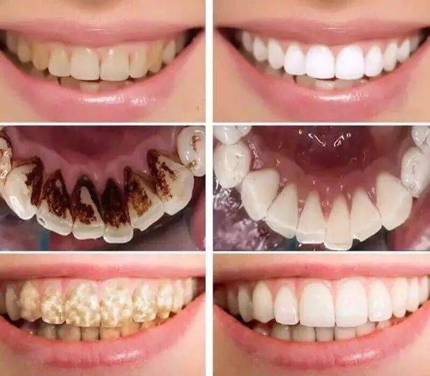 用它漱口,堪比千元洗牙!