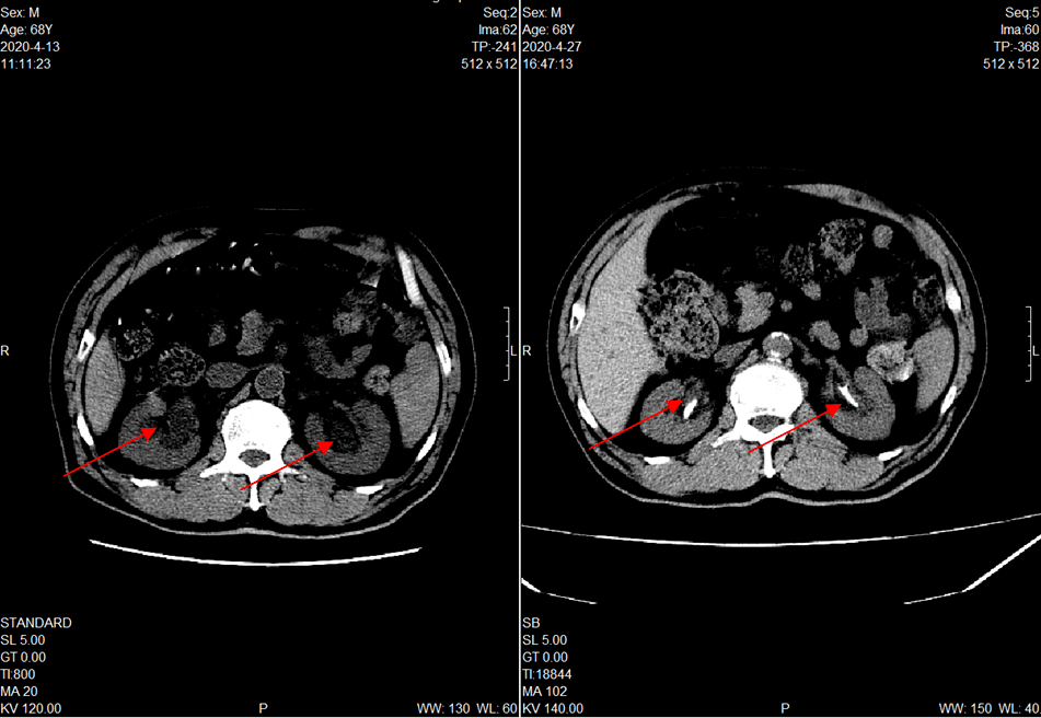 【典型案例】肿瘤合并肾衰=丧失化疗机会?no!
