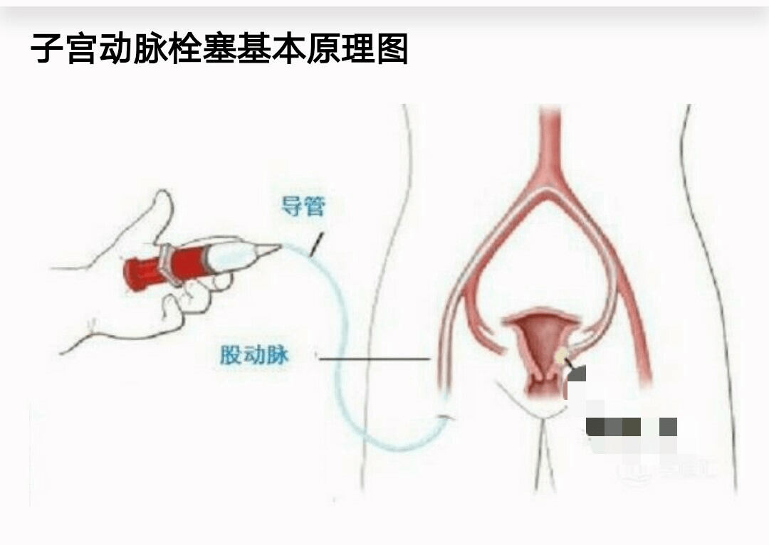 子宫动脉栓塞术ppt图片