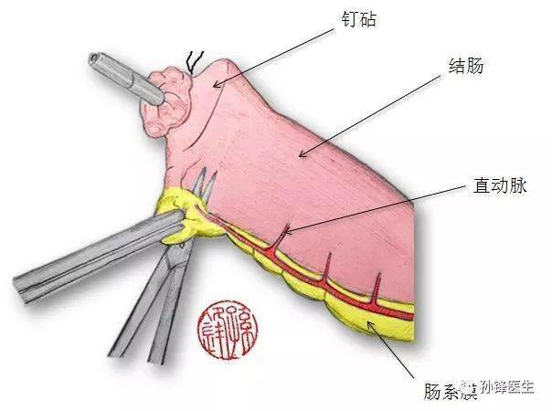 如遊離腸管僅1cm,則手工2層吻合時縫合距離比較勉強,採用25mm以上吻合