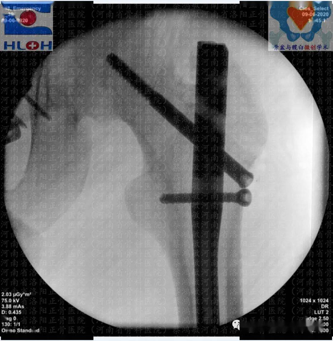 思考,明辨,活用:脊柱骨盆不連,骨盆垂直不穩定型骨折合併股骨幹粉碎性