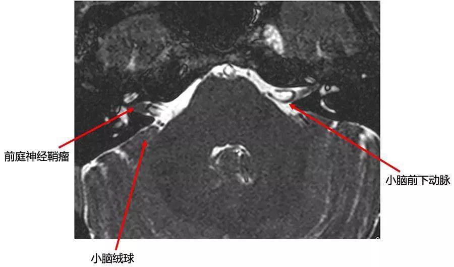 桥小脑角区解剖图MRI图片