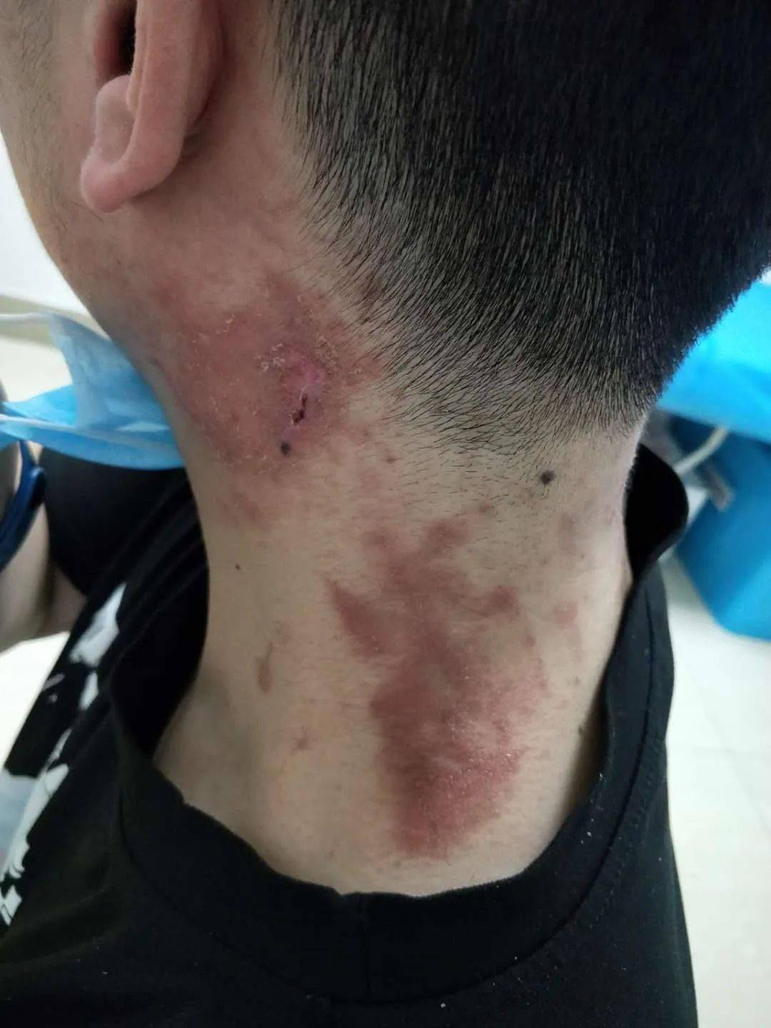 小伙随手捏死一只虫一觉醒来满脸脓包这些虫不能拍严重可致命