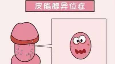 皮脂腺的分泌会受到雄激素的影响,所以在青春期后,随着雄激素分泌的
