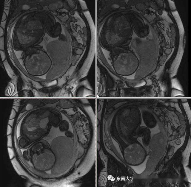 核磁共振胎盘植入图片图片