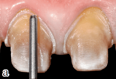 减少软组织创伤的牙体预备方案全冠及固定桥的预备体终止线