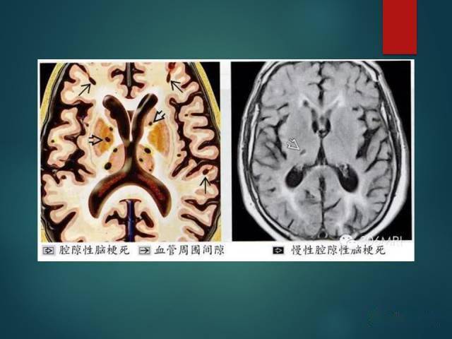 脫髓鞘疾病腔隙性腦梗死與血管周圍間隙的鑑別診斷