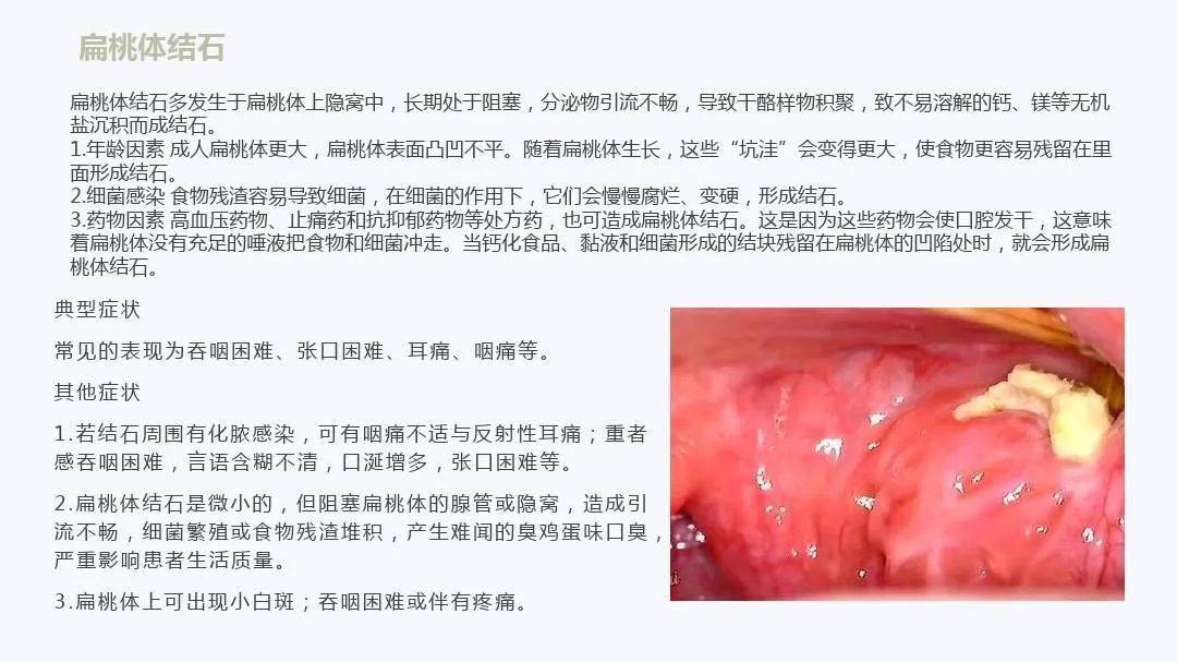 扁桃體詳細解剖