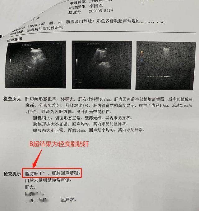 【注意】11岁娃体重130斤,一查竟是重度肝硬化!身体这些信号要警惕