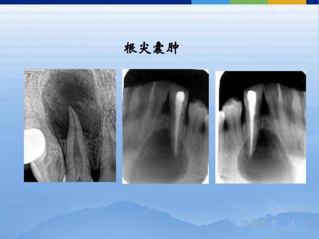 牙体牙周正常解剖及常见病x线表现