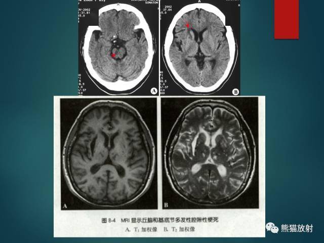 脫髓鞘疾病,腔隙性腦梗死與血管周圍間隙的鑑別診斷_信號