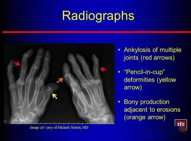 228psoriaticarthritis银屑病关节炎