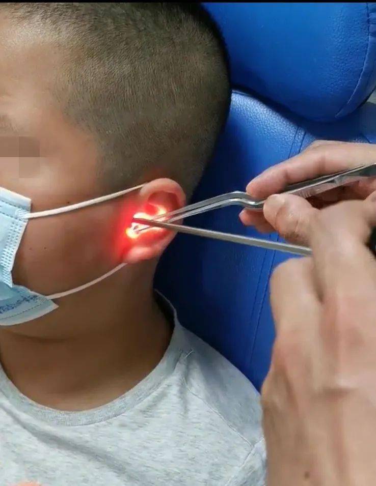 12岁男孩竟将钢珠塞进耳朵