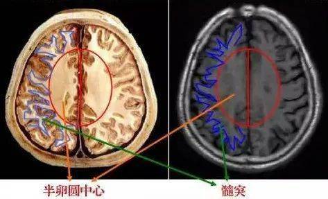 放射冠与半卵圆中心的区别_手机搜狐网